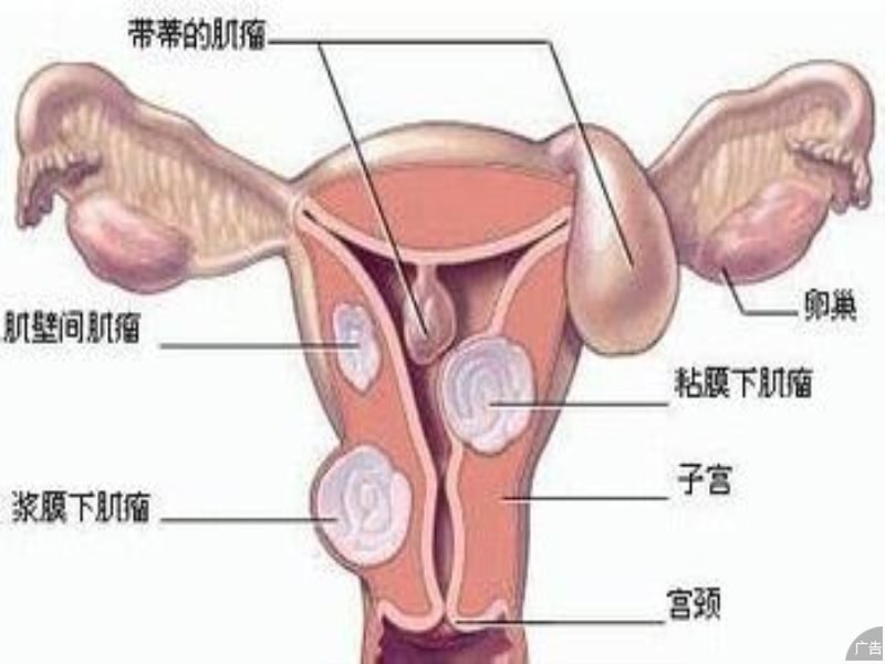 治疗子宫肌瘤需要多少钱?