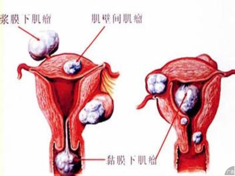 子宫肌瘤的常规检查方法有什么?
